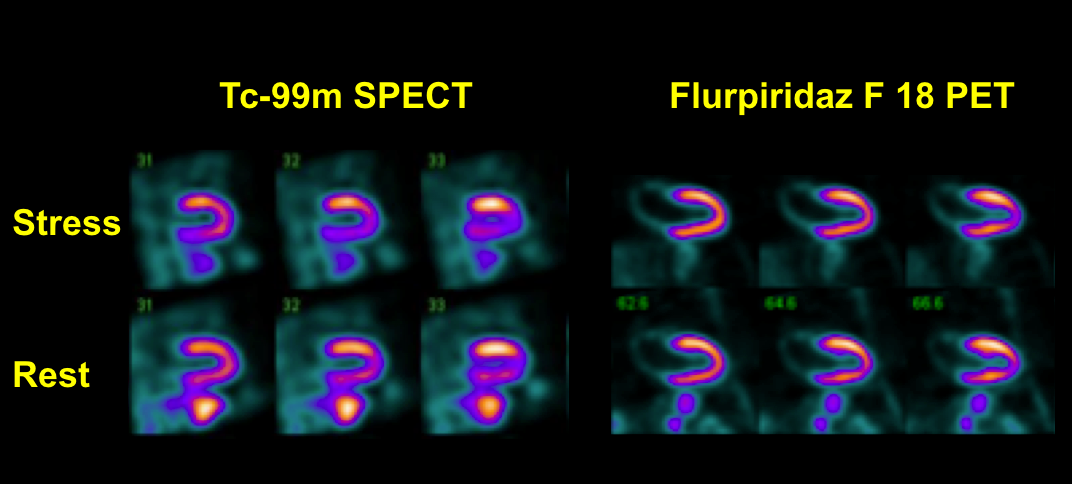 Flurpiridaz F-18 May Expand PET for Myocardial Perfusion Imaging
